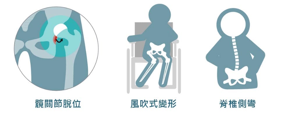 與擺位息息相關的三種姿勢問題-髖關節脫位、風吹式變形及脊椎側彎 髖關節脫位 風吹式變形 脊椎側彎