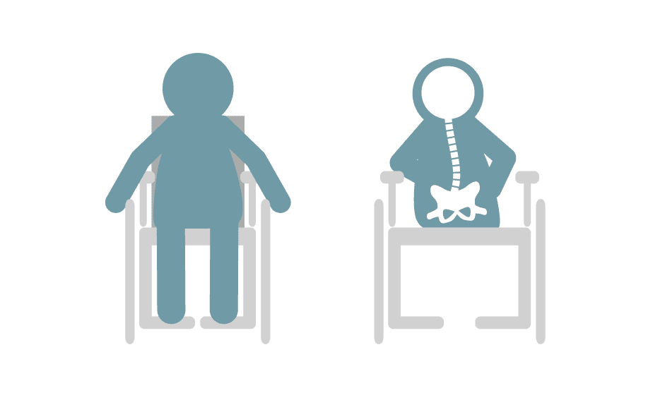 兒童輪椅與成人輪椅有什麼差別？ 左圖：正確的座椅寬度。右邊：不正確的座椅寬度，使用者被迫向一側傾斜。